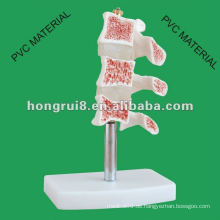 Typische Läsionen der Wirbelsäule Modell ------- Cutaway Osteoporose